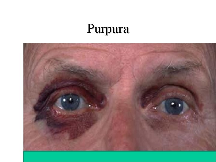 Purpura 