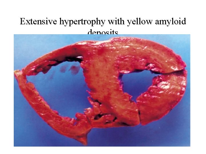 Extensive hypertrophy with yellow amyloid deposits 