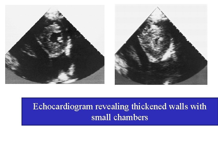 Echocardiogram revealing thickened walls with small chambers 