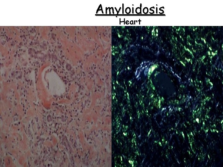 Amyloidosis Heart 