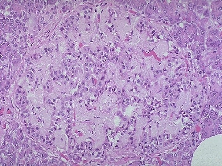 This islet of Langerhans demonstrates pink hyalinization (with deposition of amyloid) in many of
