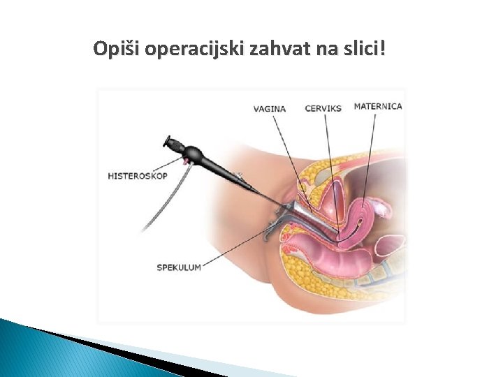 Opiši operacijski zahvat na slici! 