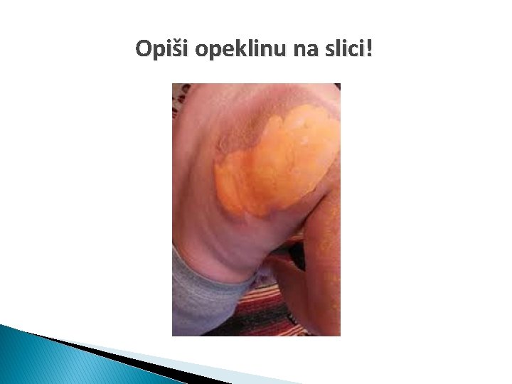 Opiši opeklinu na slici! 