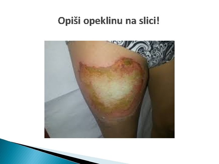 Opiši opeklinu na slici! 