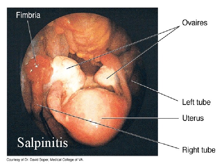 28 Salpinitis 1/10/2022 28 Salpinitis 1/10/2022