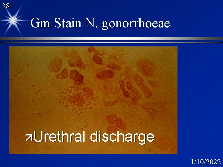 38 Gm Stain N. gonorrhoeae äUrethral discharge 1/10/2022 38 Gm Stain N. gonorrhoeae äUrethral discharge 1/10/2022