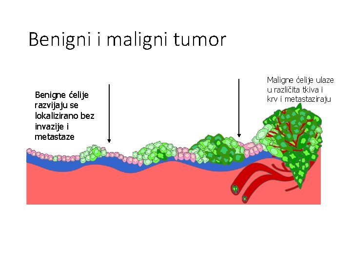 Benigni i maligni tumor Benigne ćelije razvijaju se lokalizirano bez invazije i metastaze Maligne