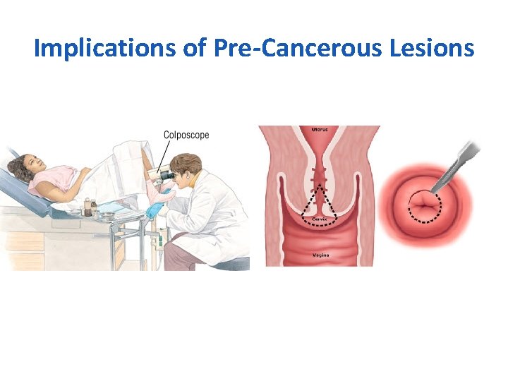 Implications of Pre-Cancerous Lesions 