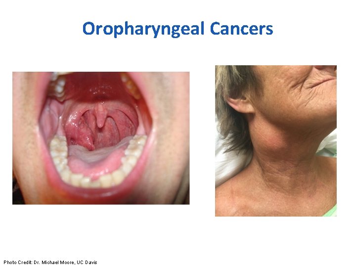 Oropharyngeal Cancers Photo Credit: Dr. Michael Moore, UC Davis 