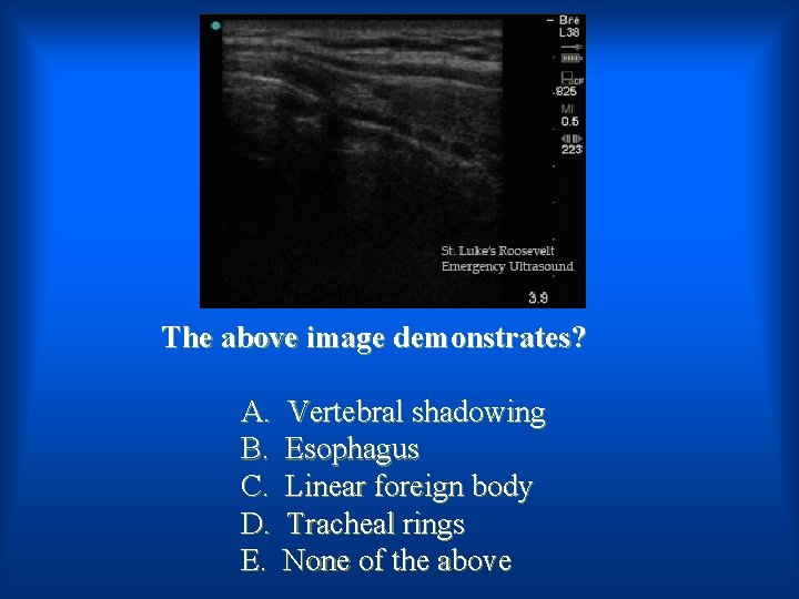The above image demonstrates? A. B. C. D. E. Vertebral shadowing Esophagus Linear foreign