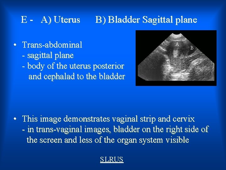 E - A) Uterus B) Bladder Sagittal plane • Trans-abdominal - sagittal plane -
