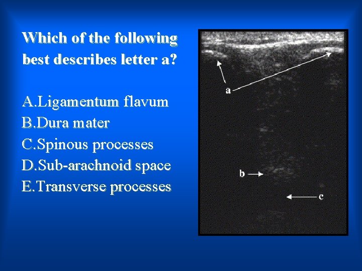 Which of the following best describes letter a? A. Ligamentum flavum B. Dura mater