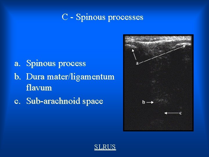 C - Spinous processes a. Spinous process b. Dura mater/ligamentum flavum c. Sub-arachnoid space