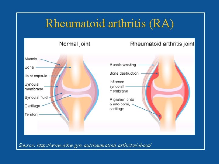 Rheumatoid arthritis (RA) Source: http: //www. aihw. gov. au/rheumatoid-arthritis/about/ 