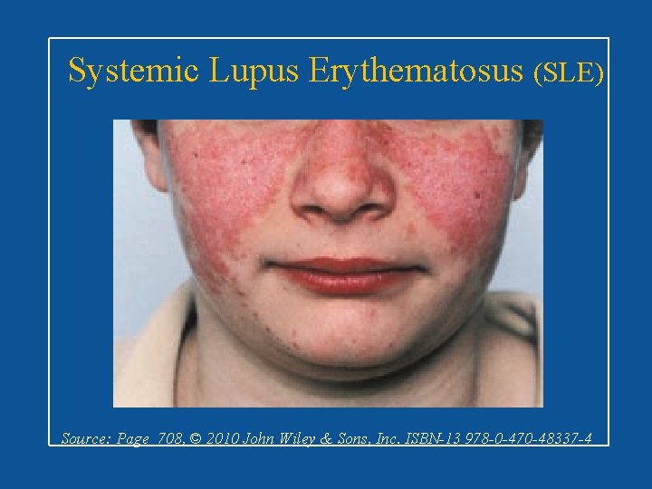 Systemic Lupus Erythematosus (SLE) Source: Page 708, © 2010 John Wiley & Sons, Inc.