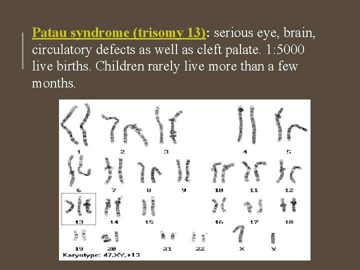 Patau syndrome (trisomy 13): serious eye, brain, circulatory defects as well as cleft palate. Patau syndrome (trisomy 13): serious eye, brain, circulatory defects as well as cleft palate.