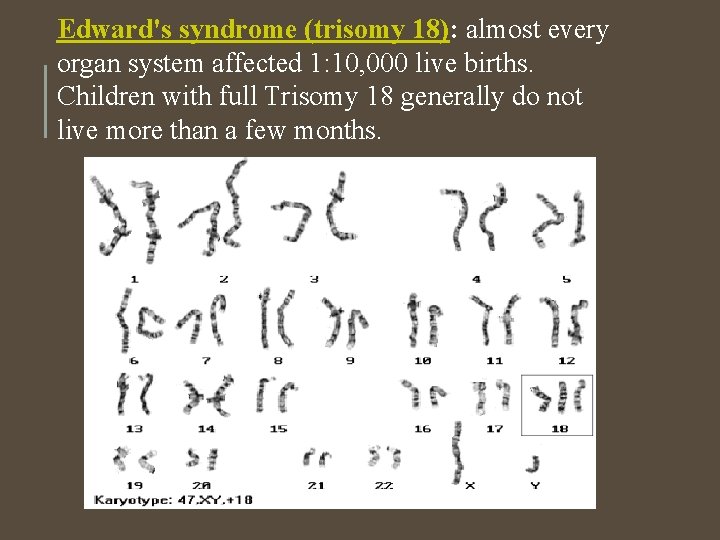 Edward's syndrome (trisomy 18): almost every organ system affected 1: 10, 000 live births. Edward's syndrome (trisomy 18): almost every organ system affected 1: 10, 000 live births.