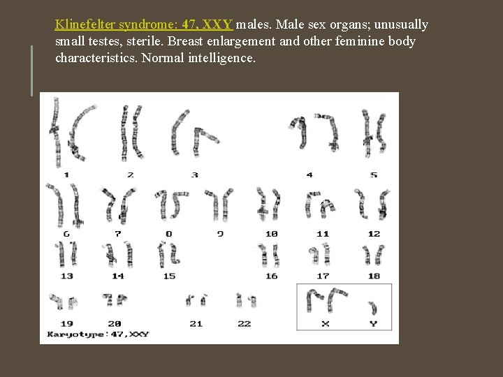 Klinefelter syndrome: 47, XXY males. Male sex organs; unusually small testes, sterile. Breast enlargement Klinefelter syndrome: 47, XXY males. Male sex organs; unusually small testes, sterile. Breast enlargement