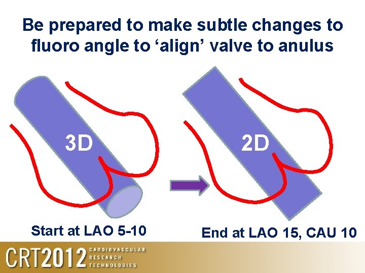 Be prepared to make subtle changes to fluoro angle to ‘align’ valve to anulus