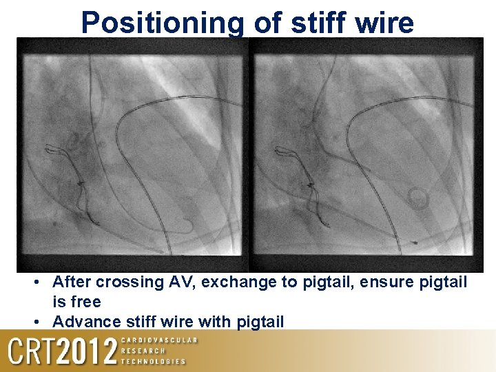 Positioning of stiff wire • After crossing AV, exchange to pigtail, ensure pigtail is