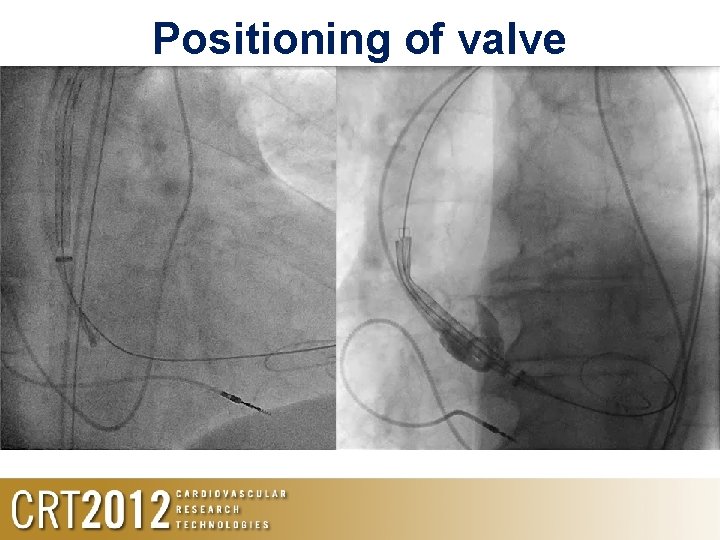 Positioning of valve 