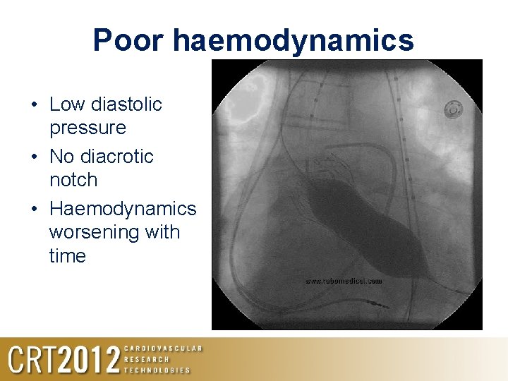 Poor haemodynamics • Low diastolic pressure • No diacrotic notch • Haemodynamics worsening with