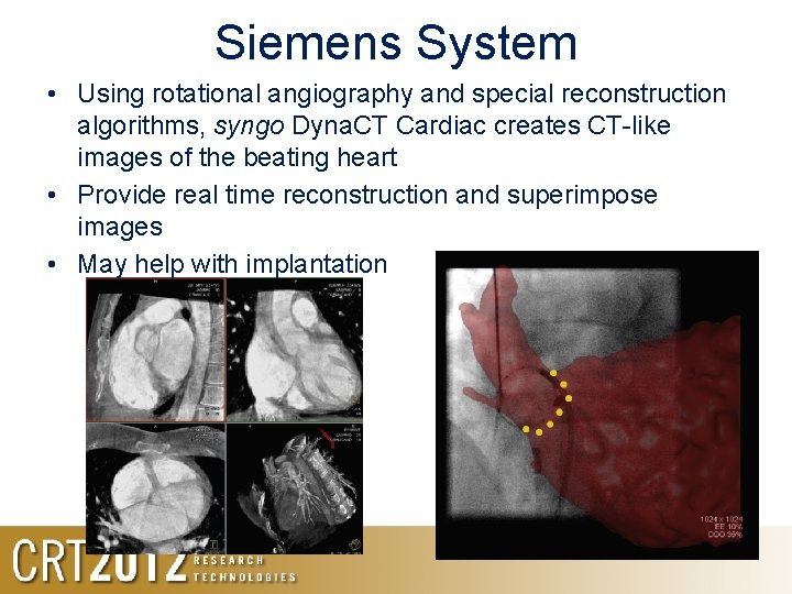 Siemens System • Using rotational angiography and special reconstruction algorithms, syngo Dyna. CT Cardiac