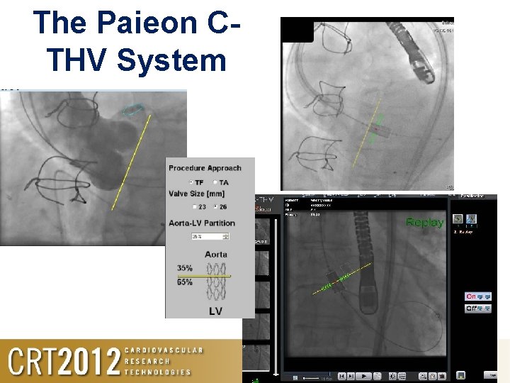 The Paieon CTHV System 