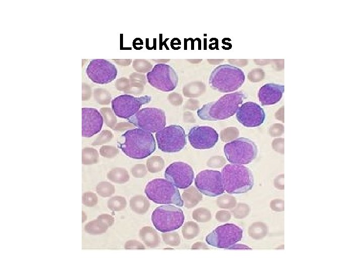 Leukemias 