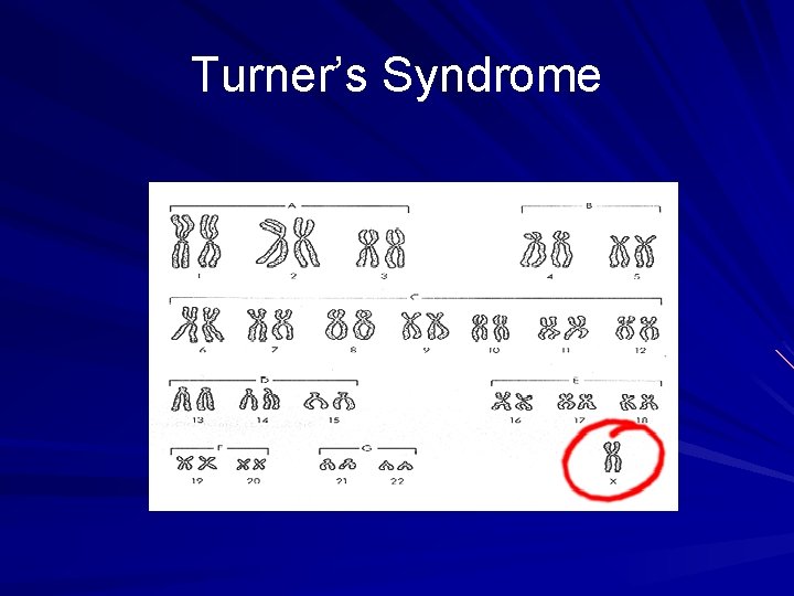 Turner’s Syndrome Turner’s Syndrome