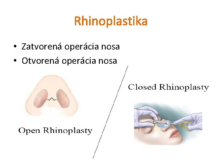 Rhinoplastika • Zatvorená operácia nosa • Otvorená operácia nosa 