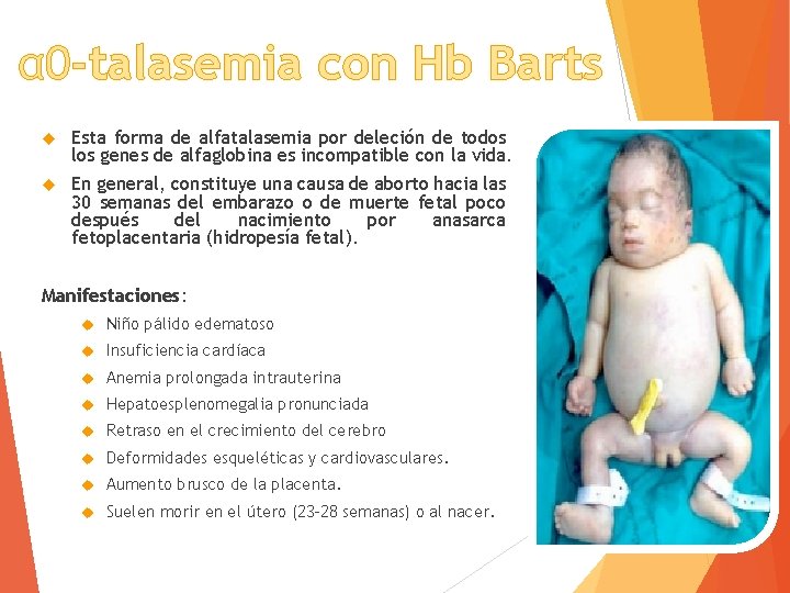 α 0 -talasemia con Hb Barts Esta forma de alfatalasemia por deleción de todos