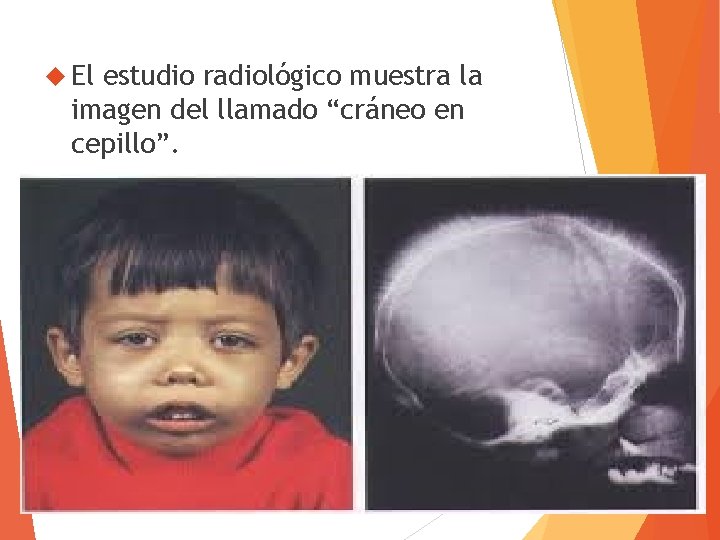  El estudio radiológico muestra la imagen del llamado “cráneo en cepillo”. 