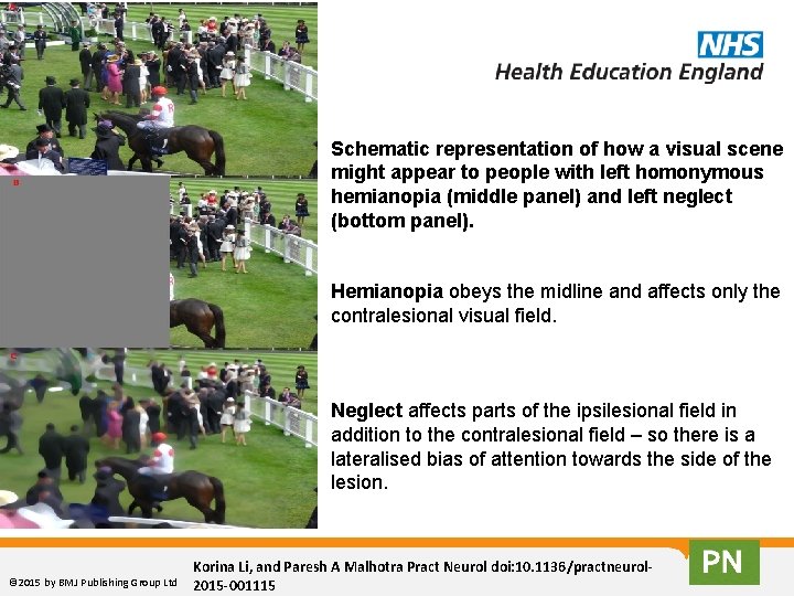 Schematic representation of how a visual scene might appear to people with left homonymous