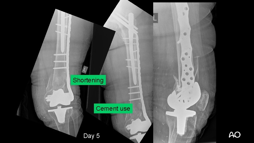 Shortening Cement use Day 5 