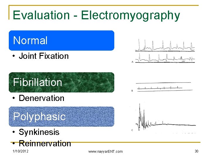 Evaluation - Electromyography Normal • Joint Fixation Fibrillation • Denervation Polyphasic • Synkinesis •