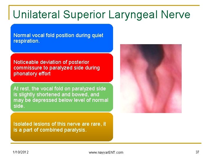 Unilateral Superior Laryngeal Nerve Injury Normal vocal fold position during quiet respiration. Noticeable deviation