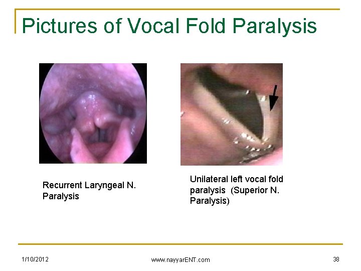 Pictures of Vocal Fold Paralysis Recurrent Laryngeal N. Paralysis 1/10/2012 Unilateral left vocal fold
