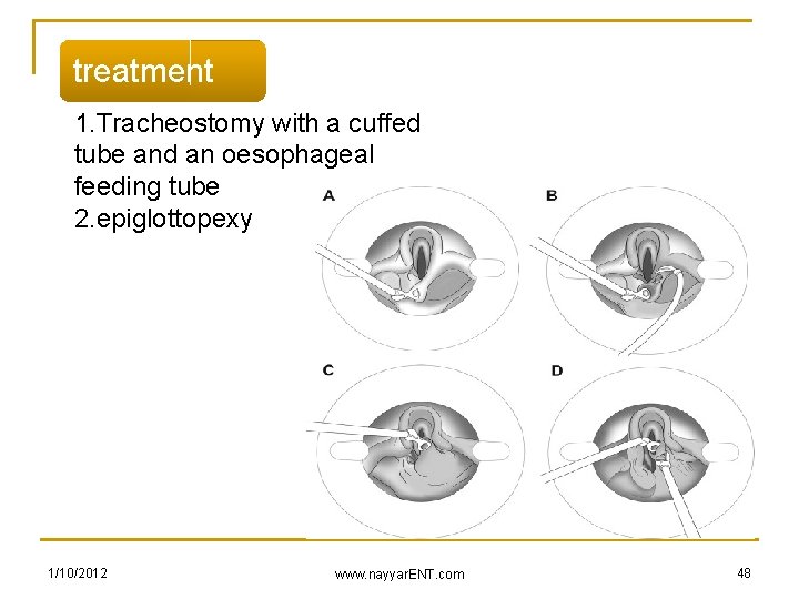 treatment 1. Tracheostomy with a cuffed tube and an oesophageal feeding tube 2. epiglottopexy