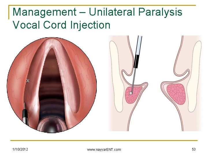 Management – Unilateral Paralysis Vocal Cord Injection 1/10/2012 www. nayyar. ENT. com 53 
