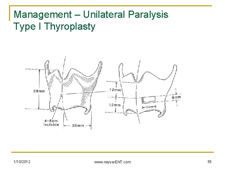 Management – Unilateral Paralysis Type I Thyroplasty 1/10/2012 www. nayyar. ENT. com 55 