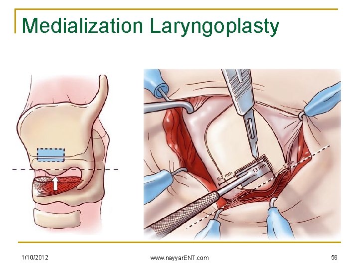 Medialization Laryngoplasty 1/10/2012 www. nayyar. ENT. com 56 