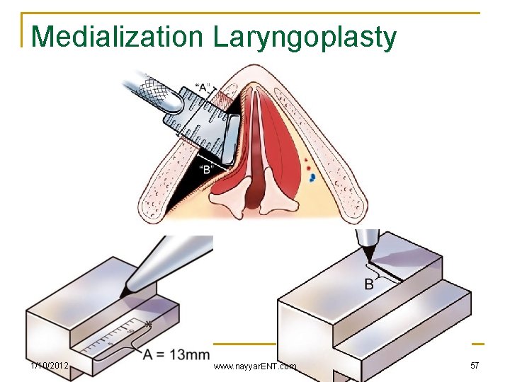 Medialization Laryngoplasty 1/10/2012 www. nayyar. ENT. com 57 