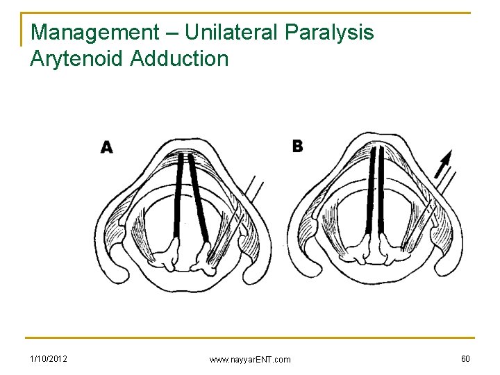Management – Unilateral Paralysis Arytenoid Adduction 1/10/2012 www. nayyar. ENT. com 60 