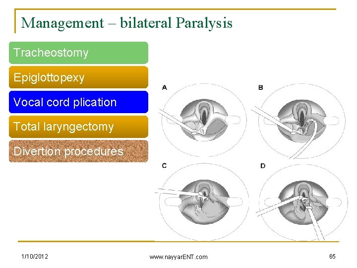 Management – bilateral Paralysis Tracheostomy Epiglottopexy Vocal cord plication Total laryngectomy Divertion procedures 1/10/2012