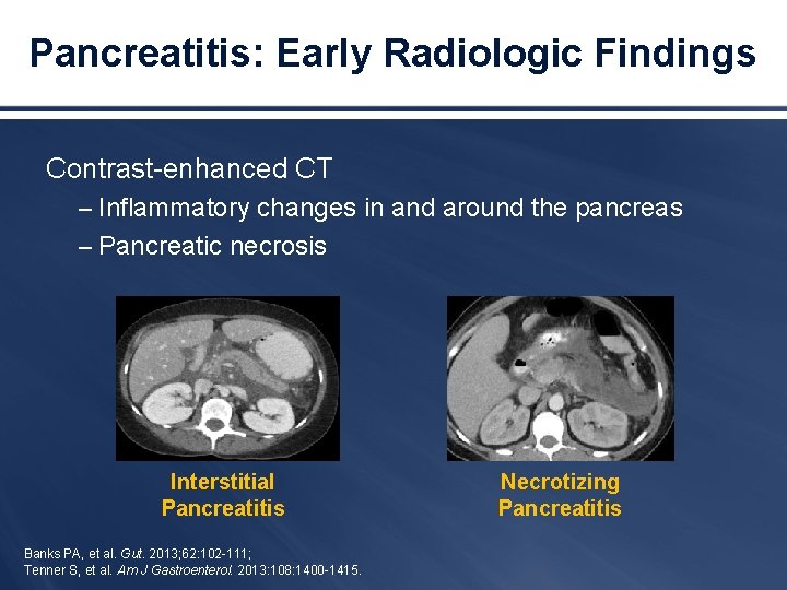 Pancreatitis: Early Radiologic Findings Contrast-enhanced CT – Inflammatory changes in and around the pancreas