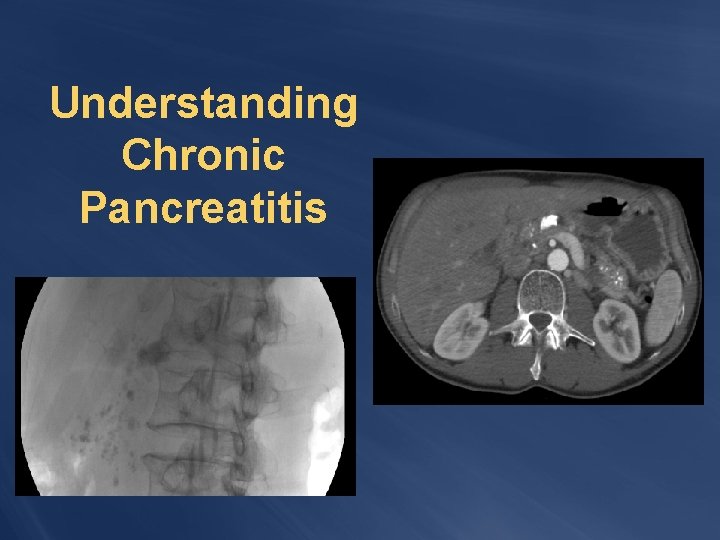 Understanding Chronic Pancreatitis 