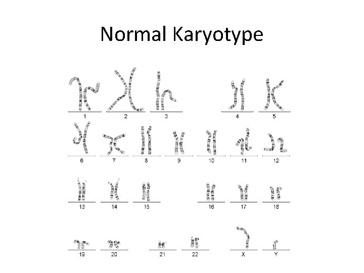 Normal Karyotype 