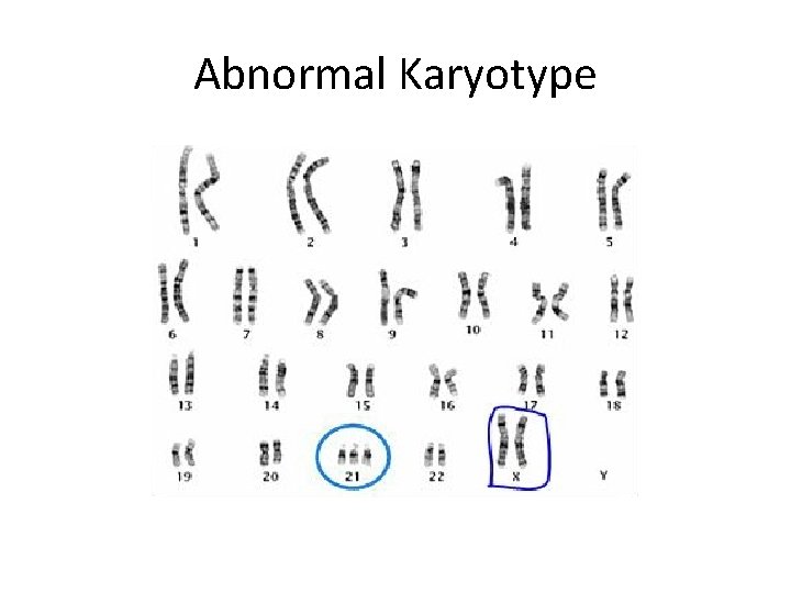 Abnormal Karyotype 