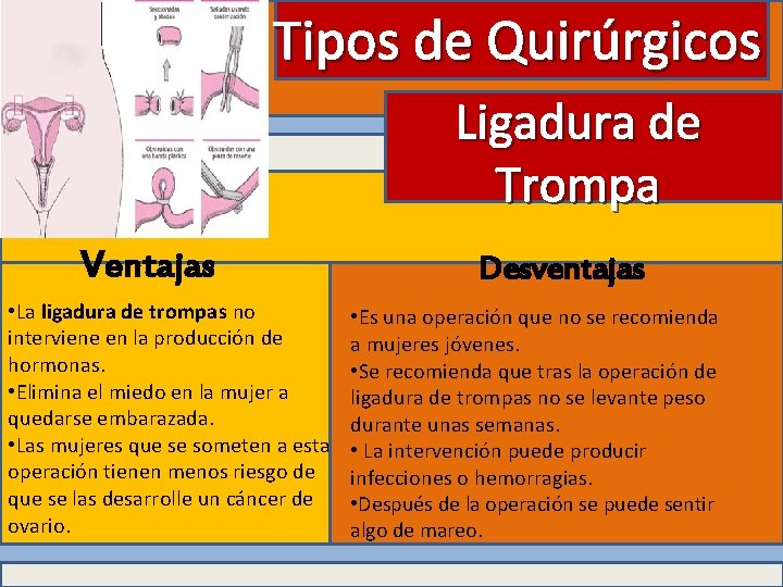 Tipos de Quirúrgicos Ligadura de Trompa Ventajas • La ligadura de trompas no interviene